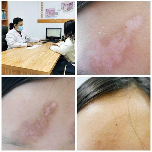 头上白斑病图片,成因、症状及防治策略