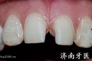 坏牙齿图片,从坏牙图片看口腔健康隐患