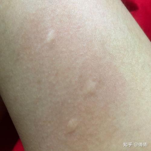 蚊子咬的包图片大全,揭秘不同类型蚊包的奥秘