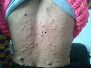 什么是肉瘤图片大全,认识这一类恶性肿瘤